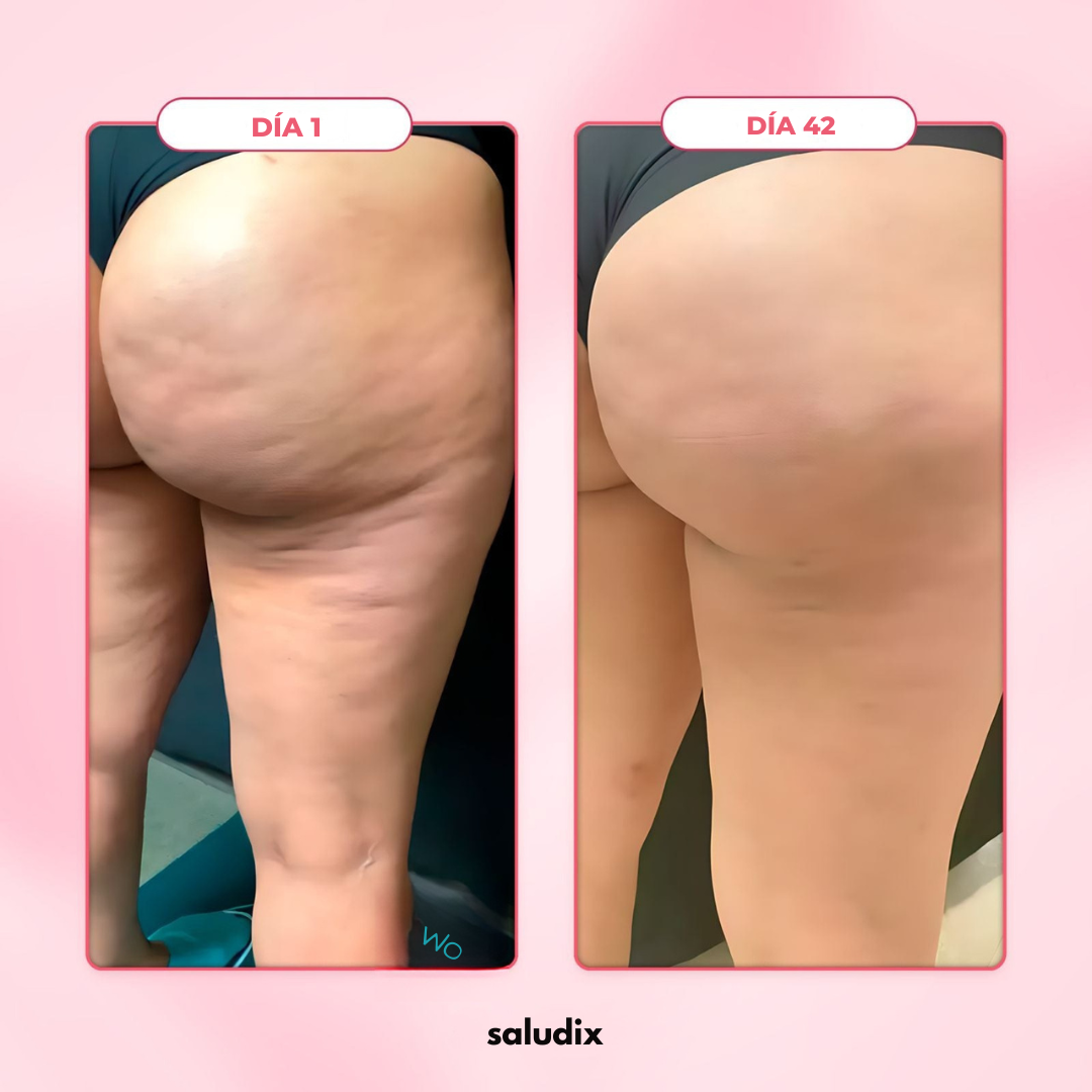 Masajeador Anticelulitis Eléctrico